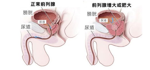 淮安男性患了前列腺增生的症状表现？