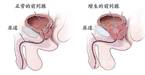 淮安男性夜里尿多是前列腺增生吗？